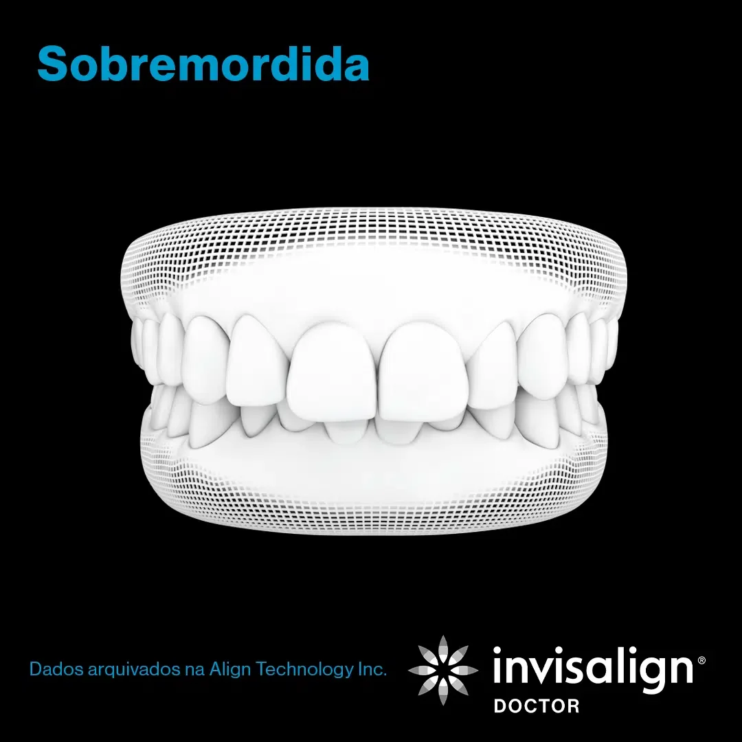 Sobremordida
