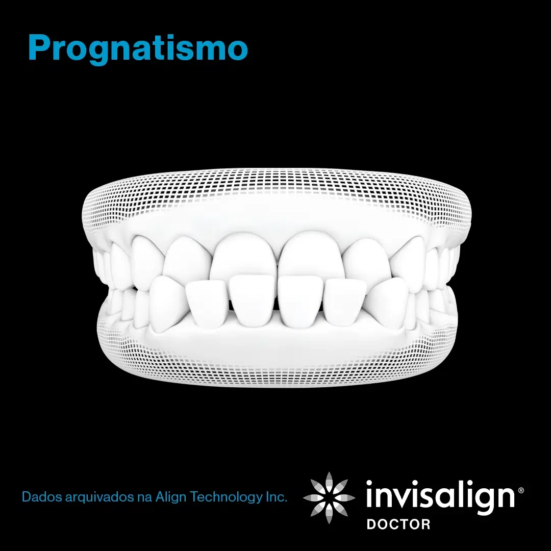 Prognatismo