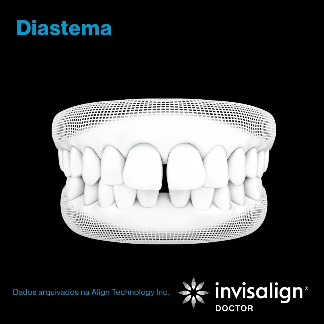 Diastema