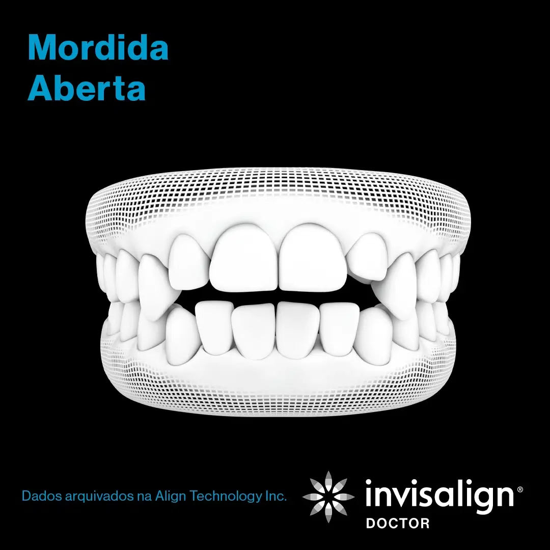 Mordida Aberta