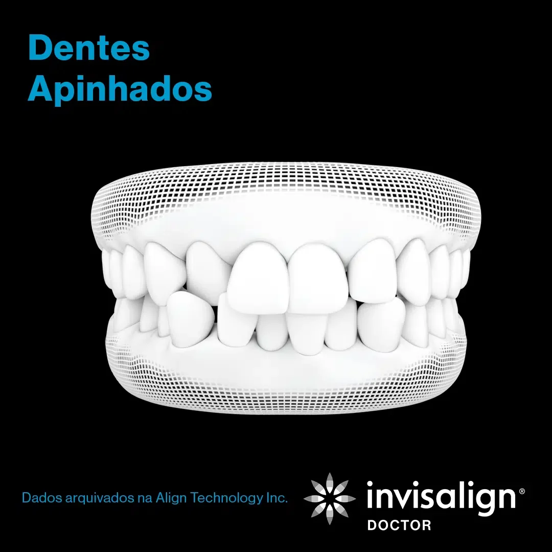 Dentes Apinhados
